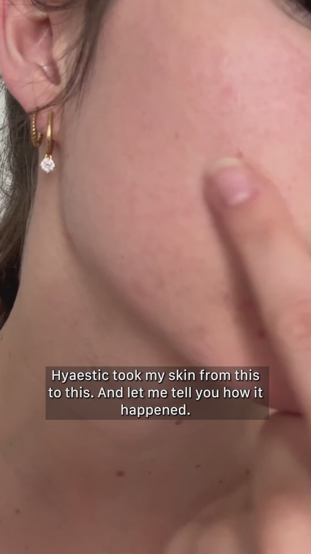 Hyaestic 0,5% Pure Retinol
